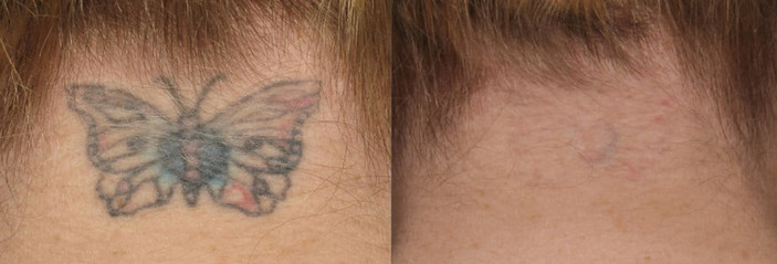 Tattoo removal in back neck