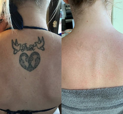 Tattoo removal in upper back