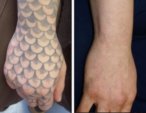 Tattoo removal in forearm