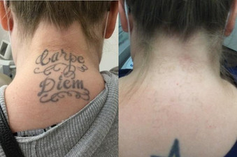 Tattoo removal in back neck