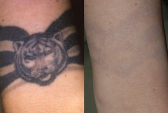 Tattoo removal in forearm