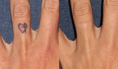 Tattoo removal in finger