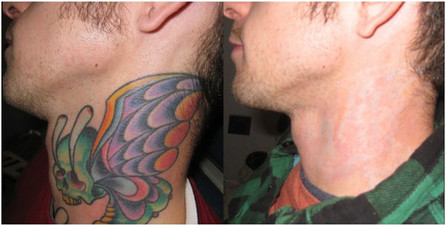 Tattoo removal in neck