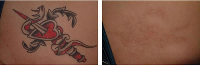 Tattoo removal in stomach